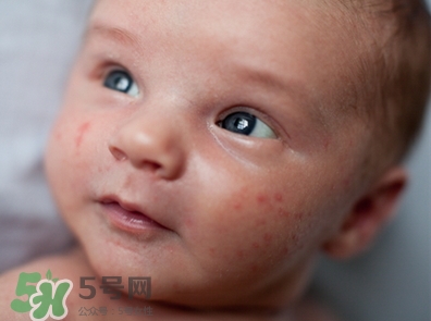 新生兒痤瘡怎么治療-癥狀 新生兒痤瘡怎么治療-癥狀