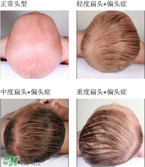 寶寶頭型是睡出來(lái)的嗎？寶寶頭型矯正最佳時(shí)間