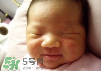 新生兒痤瘡怎么治療-癥狀 新生兒痤瘡怎么治療-癥狀