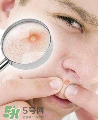 痘痘是如何形成的？食物祛痘法