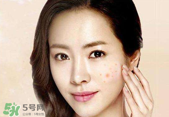 痘痘是如何形成的？食物祛痘法