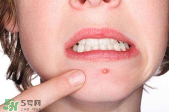 暗瘡可以擠壓嗎？油性和骯臟肌膚會(huì)容易有暗瘡嗎？