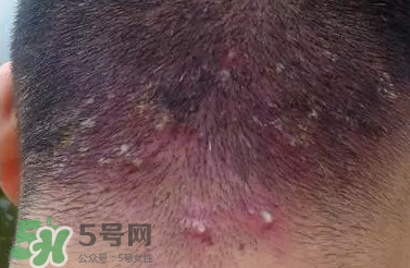 痤瘡和毛囊炎一樣嗎？痤瘡與毛囊炎區(qū)別