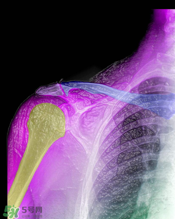 骨刺是怎么形成的？骨刺怎么治療？