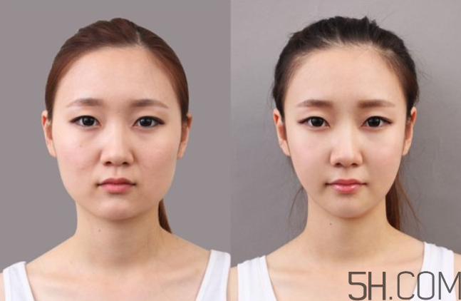 瘦臉針有依賴嗎？打瘦臉針有依賴性嗎？