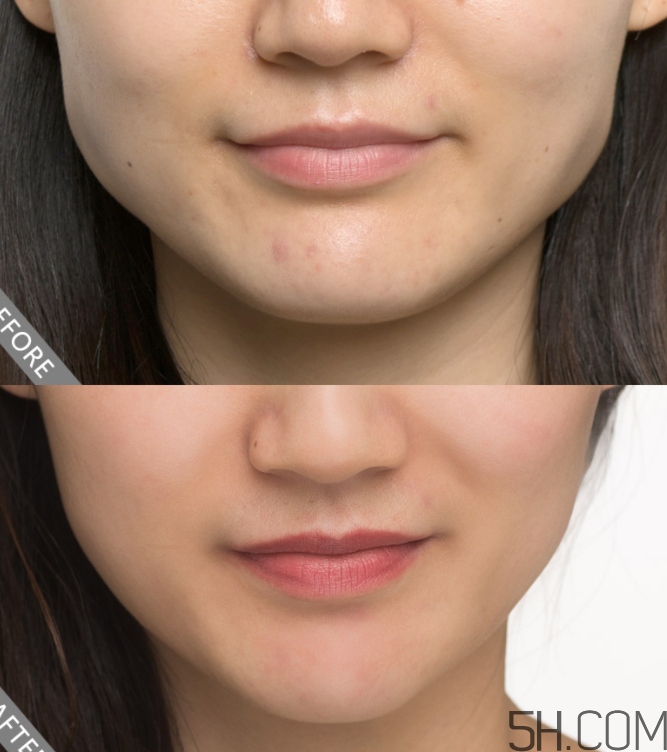 瘦臉針需要打幾次有效？瘦臉針需要打幾次定型？