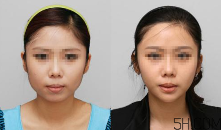 瘦臉針要做皮試嗎？瘦臉針皮試怎么做？