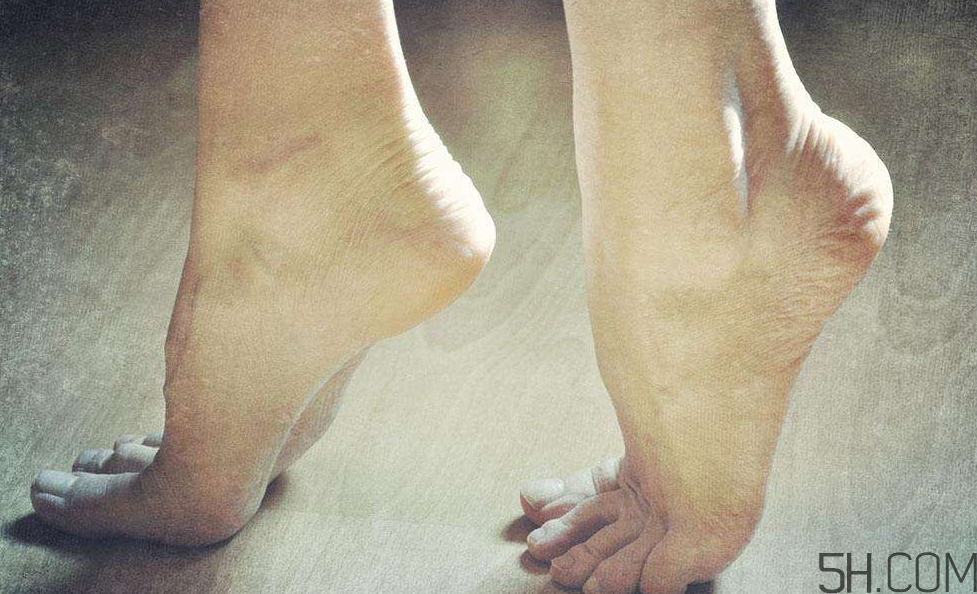 腳氣是什么原因引起的？腳氣是濕氣重引起的嗎?