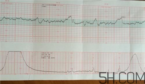 為什么要做胎心監(jiān)護(hù)？孕婦做胎心監(jiān)護(hù)有什么用？