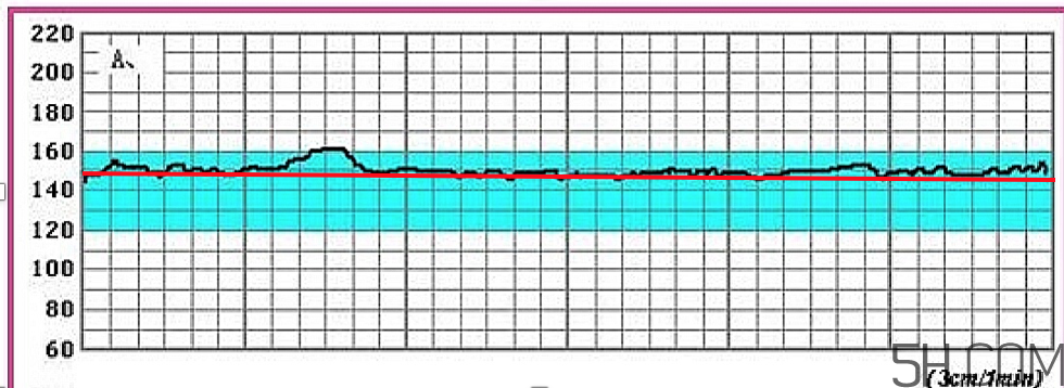 為什么要做胎心監(jiān)護(hù)？孕婦做胎心監(jiān)護(hù)有什么用？