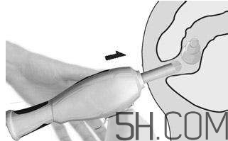 開塞露怎么用？開塞露用后多久會排便？