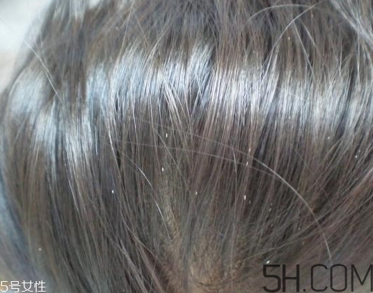 頭虱和頭皮屑怎么區(qū)分？頭虱是怎樣生成的