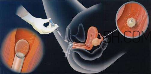 人工授精取卵子怎么??？人工授精男人怎樣取精？