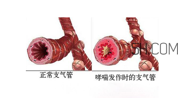 哮喘應(yīng)該看什么科?哮喘應(yīng)該吃什么藥? 哮喘應(yīng)該看什么科?哮喘應(yīng)該吃什么藥?