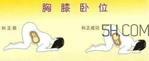 什么情況下需要剖腹產(chǎn) 剖腹產(chǎn)最全科普 什么情況下需要剖腹產(chǎn) 剖腹產(chǎn)最全科普