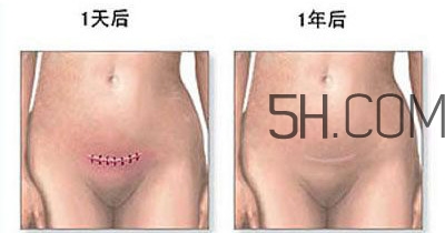 什么情況下需要剖腹產(chǎn) 剖腹產(chǎn)最全科普 什么情況下需要剖腹產(chǎn) 剖腹產(chǎn)最全科普