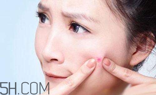 泊美祛痘系列怎么樣？泊美祛痘系列有哪些？