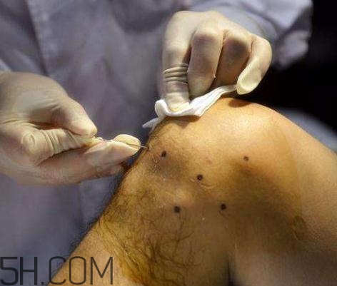 關節(jié)炎積液什么癥狀？關節(jié)炎積水怎么治療？