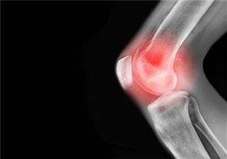 關(guān)節(jié)炎需要補(bǔ)鈣嗎？關(guān)節(jié)炎補(bǔ)鈣有用嗎？
