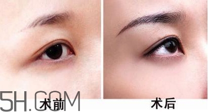 切眉手術(shù)后老得快嗎？切眉能保持多久？