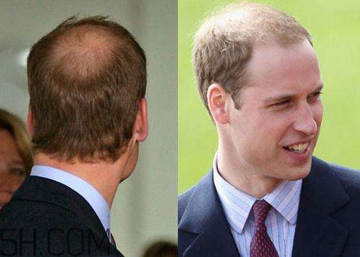 什么樣的人容易禿頂？為什么女人不禿頂