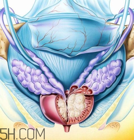 前列腺增生會不會癌變？前列腺增生能徹底治愈嗎？