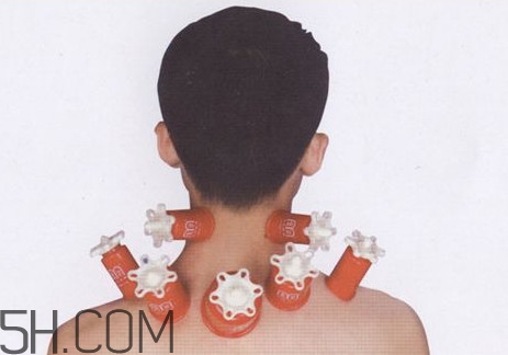 脖子可以刮痧嗎？脖子拔火罐有什么好處