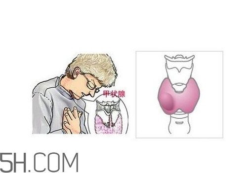 為什么會得甲狀腺結(jié)節(jié)？甲狀腺節(jié)結(jié)是什么？