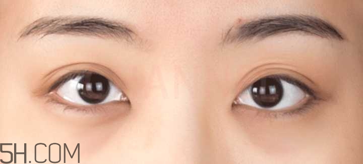 黑眼圈怎么去除既簡單有容易 看類型與程度 黑眼圈怎么去除既簡單有容易 看類型與程度