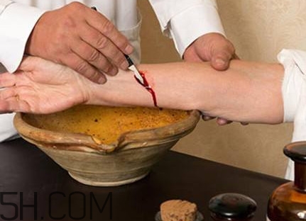 放血療法適合任何人嗎？放血療法是如何退出歷史舞臺的