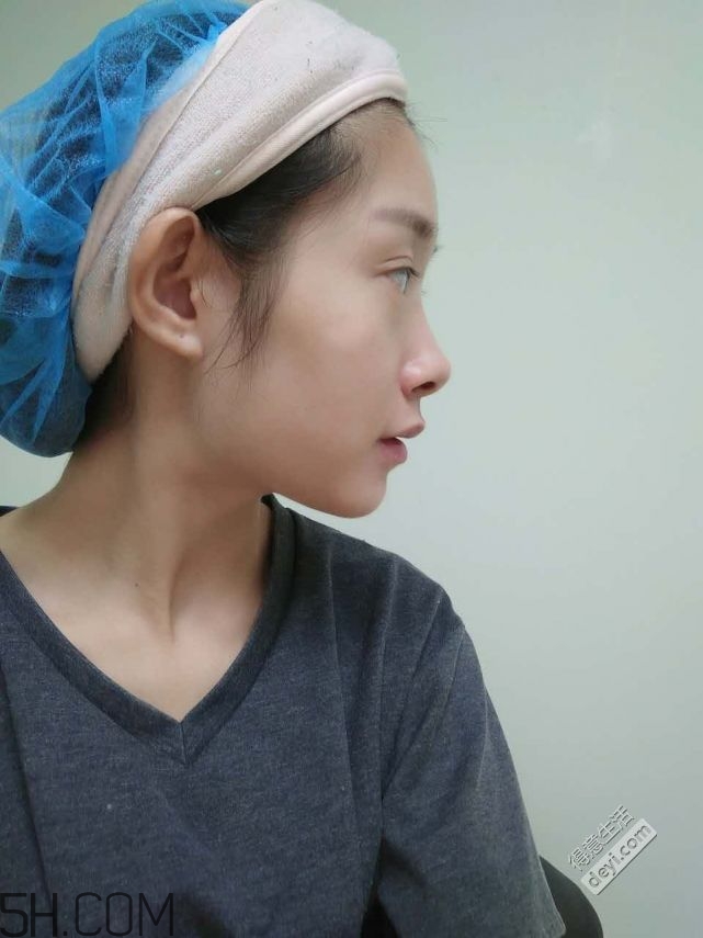 鼻頭縮小術(shù)過程圖 鼻頭縮小手術(shù)千萬別做后悔死 鼻頭縮小術(shù)過程圖 鼻頭縮小手術(shù)千萬別做后悔死