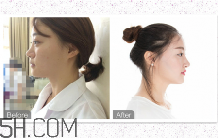 鼻頭縮小術(shù)過程圖 鼻頭縮小手術(shù)千萬別做后悔死 鼻頭縮小術(shù)過程圖 鼻頭縮小手術(shù)千萬別做后悔死