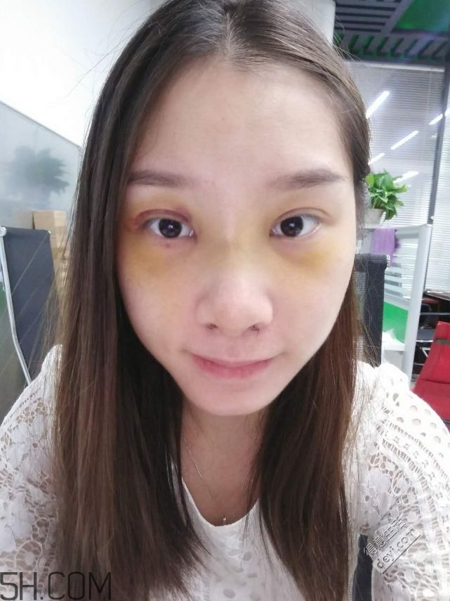 鼻頭縮小術(shù)過程圖 鼻頭縮小手術(shù)千萬別做后悔死 鼻頭縮小術(shù)過程圖 鼻頭縮小手術(shù)千萬別做后悔死