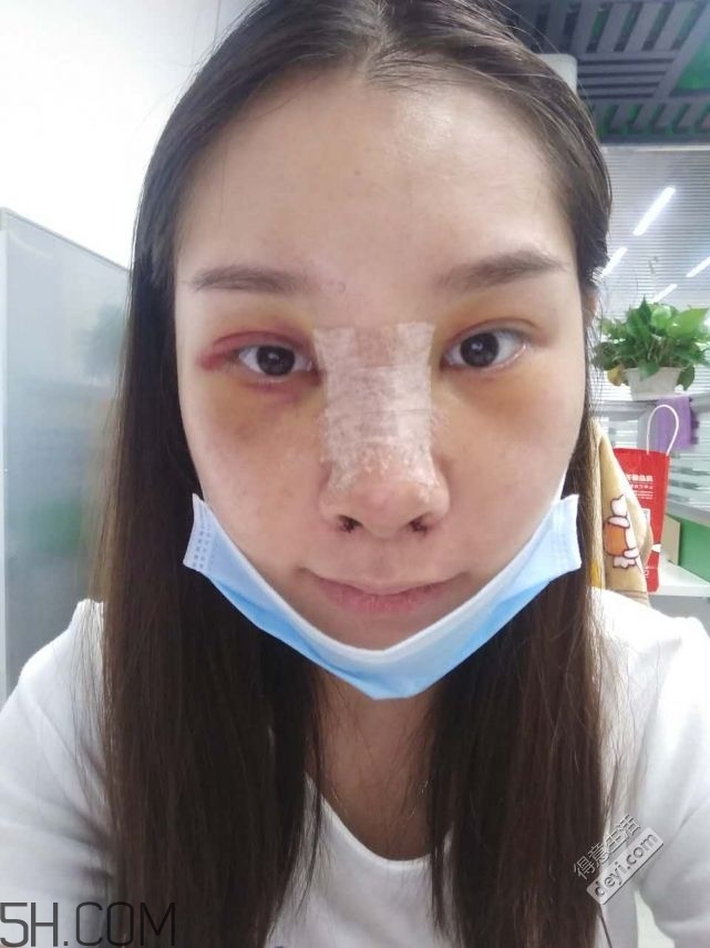 鼻頭縮小術(shù)過程圖 鼻頭縮小手術(shù)千萬別做后悔死 鼻頭縮小術(shù)過程圖 鼻頭縮小手術(shù)千萬別做后悔死