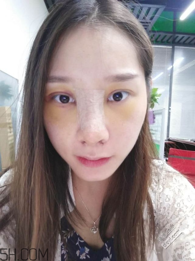 鼻頭縮小術(shù)過程圖 鼻頭縮小手術(shù)千萬別做后悔死 鼻頭縮小術(shù)過程圖 鼻頭縮小手術(shù)千萬別做后悔死