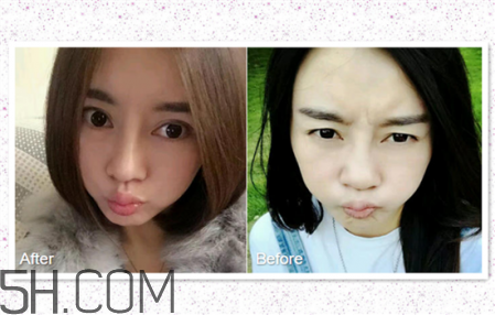 鼻頭縮小術(shù)過程圖 鼻頭縮小手術(shù)千萬別做后悔死 鼻頭縮小術(shù)過程圖 鼻頭縮小手術(shù)千萬別做后悔死