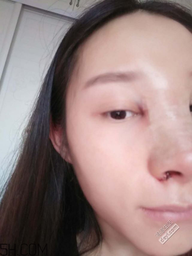 鼻頭縮小術(shù)過程圖 鼻頭縮小手術(shù)千萬別做后悔死 鼻頭縮小術(shù)過程圖 鼻頭縮小手術(shù)千萬別做后悔死