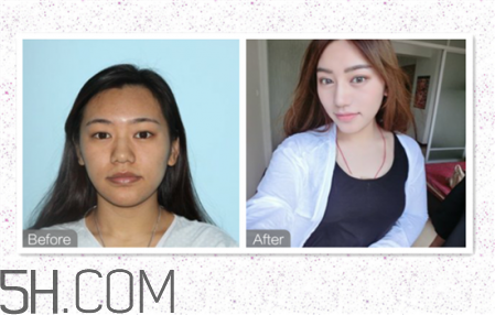 鼻頭縮小術(shù)過程圖 鼻頭縮小手術(shù)千萬別做后悔死 鼻頭縮小術(shù)過程圖 鼻頭縮小手術(shù)千萬別做后悔死