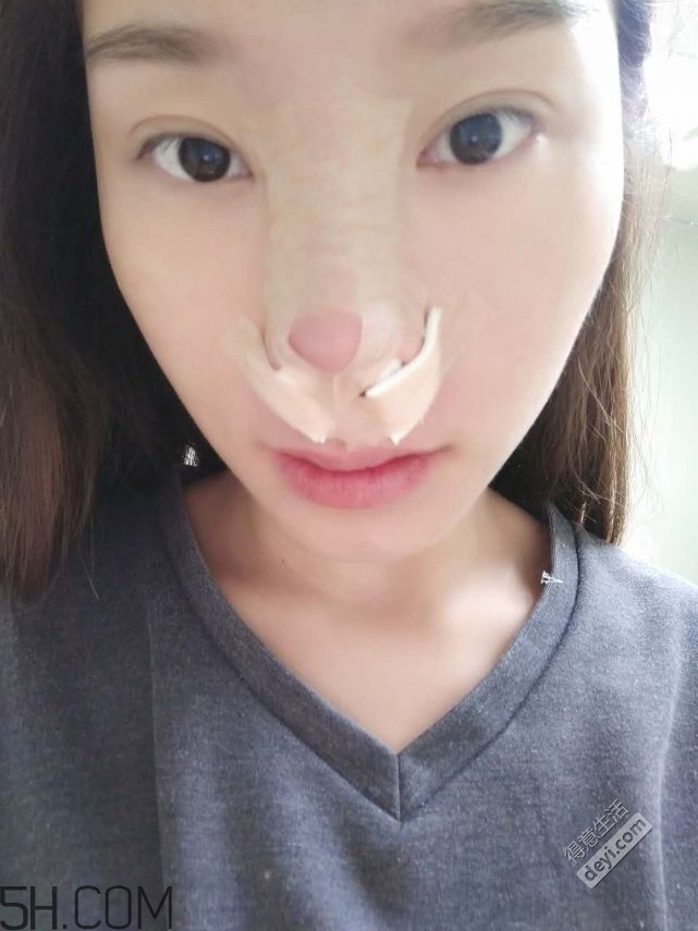 鼻頭縮小術(shù)過程圖 鼻頭縮小手術(shù)千萬別做后悔死 鼻頭縮小術(shù)過程圖 鼻頭縮小手術(shù)千萬別做后悔死