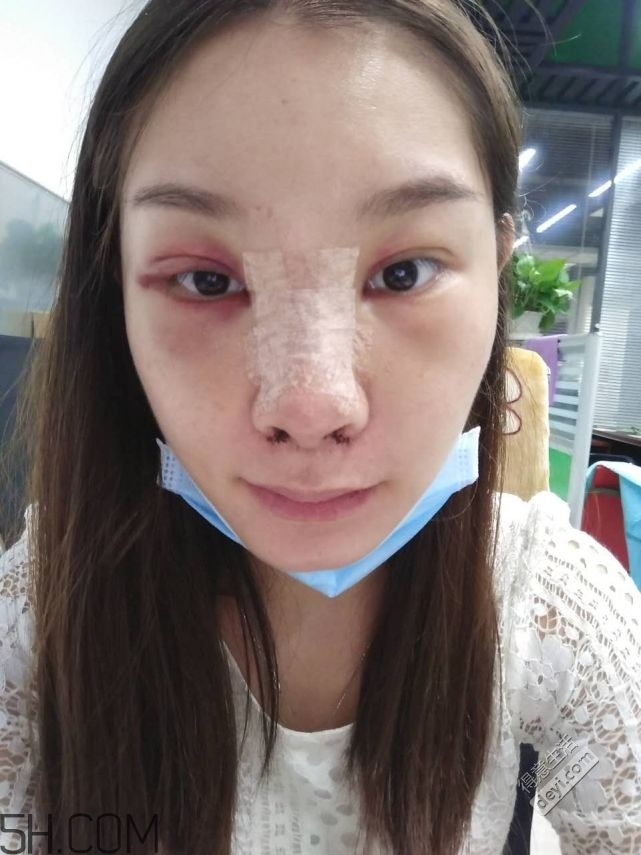 鼻頭縮小術(shù)過程圖 鼻頭縮小手術(shù)千萬別做后悔死 鼻頭縮小術(shù)過程圖 鼻頭縮小手術(shù)千萬別做后悔死