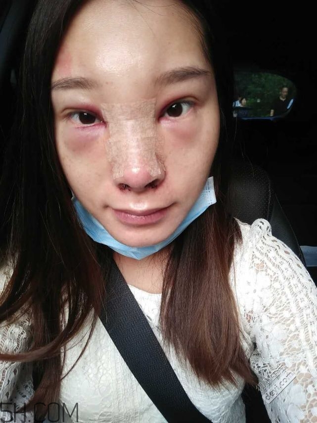 鼻頭縮小術(shù)過程圖 鼻頭縮小手術(shù)千萬別做后悔死 鼻頭縮小術(shù)過程圖 鼻頭縮小手術(shù)千萬別做后悔死