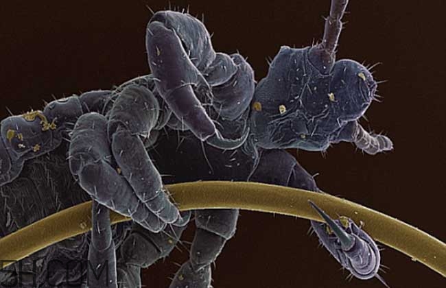 孩子長虱子是怎么回事？孩子長虱子該怎么辦？