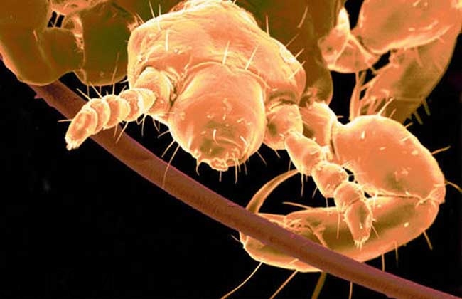 孩子長虱子是怎么回事？孩子長虱子該怎么辦？