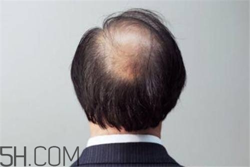 為什么男性比女性更容易脫發(fā)？什么原因?qū)е履行悦摪l(fā)？