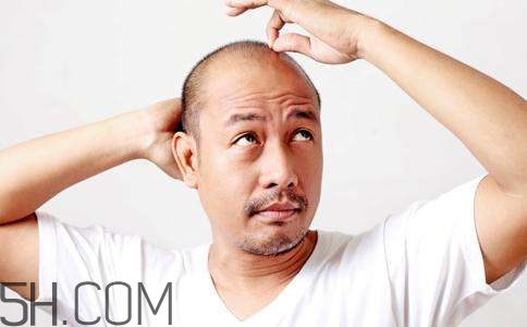 為什么男性比女性更容易脫發(fā)？什么原因?qū)е履行悦摪l(fā)？