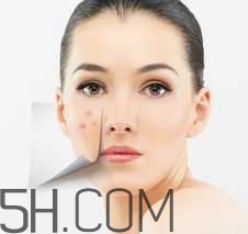 濕熱型痤瘡是什么？怎么調(diào)理濕熱型痤瘡？