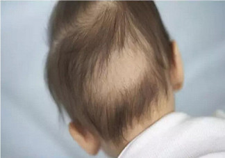 寶寶枕禿怎么辦？如何改善寶寶枕禿現(xiàn)象？