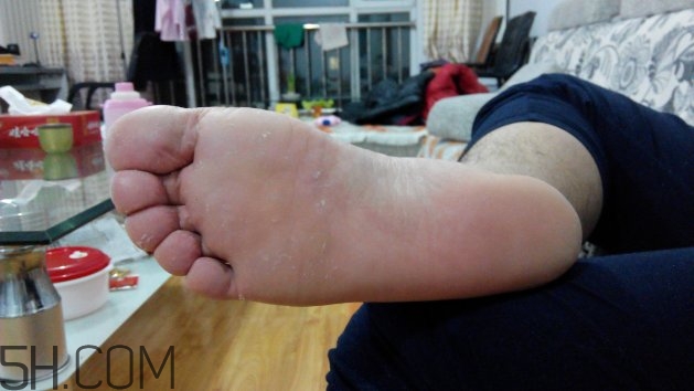 腳氣可以用酒精消毒嗎？腳氣可以用碘伏消毒嗎？