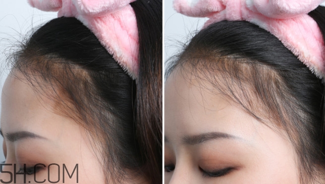 發(fā)際線不好看怎么修飾 完美解決6種發(fā)際線問題 發(fā)際線不好看怎么修飾 完美解決6種發(fā)際線問題