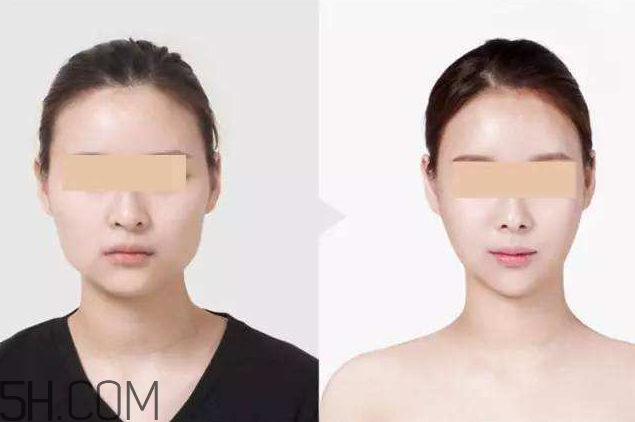 打瘦臉針可以抽煙嗎？打瘦臉針會(huì)反彈嗎？